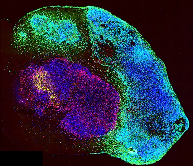 IPTO: brain organoid (green) with tumor cells (red)